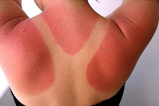 healing power of petroleum jelly for sunburn relief