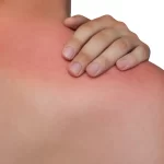 Healing Power of Petroleum Jelly for Sunburn Relief