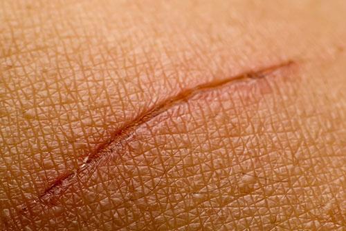 Wound Healing by Petroleum Jelly petroleum jelly in promoting wound healing