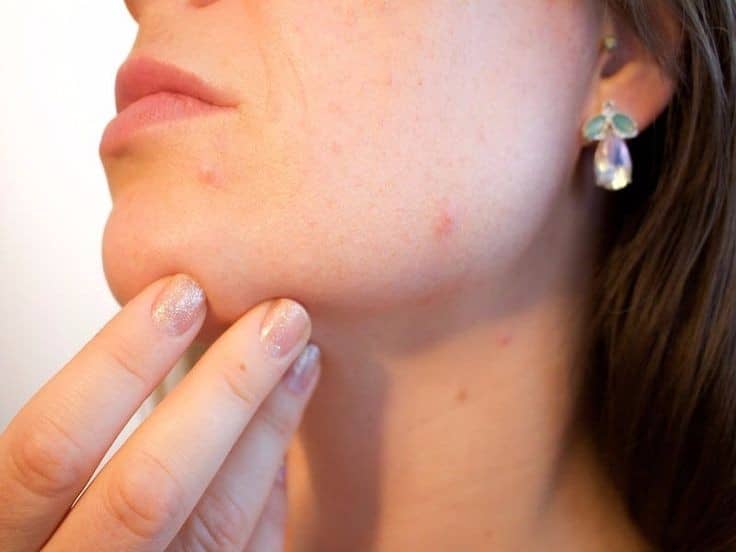Wound Healing by Petroleum Jelly petroleum jelly in promoting wound healing